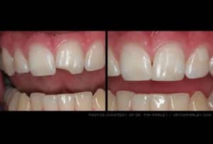 chipped tooth dentist kansas city mo