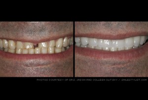 dental veneers kansas city